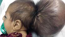 Afganistanski ljekari spasili bebu s dvije glave