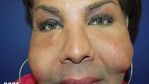 VIDEO: Lažni plastični hirurg joj ubrizgao cement u lice!