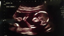 Beba pokazala podignut palac na ultrazvuku