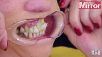 Lijepila je zube superljepilom, evo šta joj se desilo sa vilicom!