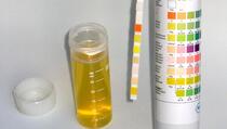  Evo šta boja urina otkriva o vašem zdravlju!