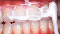 Čuvajte ovu smjesu u ustima 60 sekundi i uklonićete sav kamenac sa zuba! 