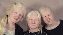 Problemi albino populacije: Gledaju nas kao da smo s druge planete