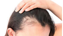  Žene se sve češće susreću s problemom gubitka kose