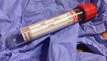 Naučnici razvili prvi krvni test za otkrivanje melanoma