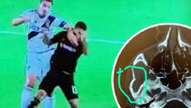Nogometaš kojeg je Ibrahimović udario laktom u glavu mora na operaciju