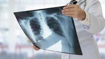Devet simptoma raka pluća na koje trebate reagirati, čak i ako ne pušite
