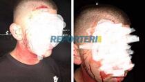 Brutalno prebijen mladić iz Vučitrna zbog kršenja policijskog časa