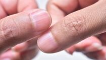 Šta znače brazde na noktima i kad je vrijeme za odlazak doktoru?
