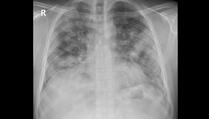 Otkriven neobičan oblik koronavirusa, ljekari mislili da je riječ o raku pluća
