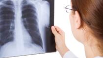 Pulmolozi upozorili: Ovo su tri glavna razloga za razvoj upale pluća