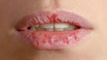 Zašto vam usne pucaju i kako ih izliječiti i zaštititi