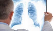 Nakon Kine i u Evropu stigao "sindrom bijelih pluća": Otporan je na penicilin, strahuje se od nove pandemije