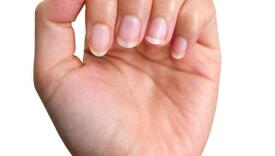 Izgled noktiju mogao bi biti pokazatelj bolesti srca, tvrde stručnjaci