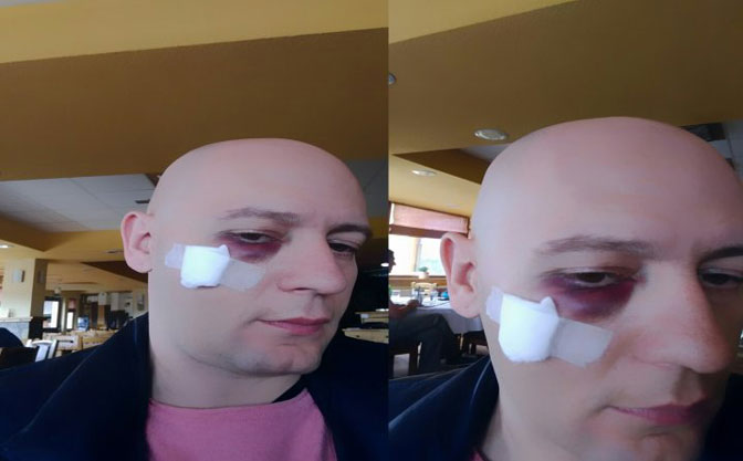 Pjevač Šaćir Ahmeti udaren flašom u glavu