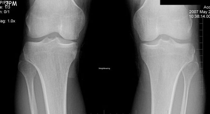 bolna bol i pucketanje u zglobu koljena