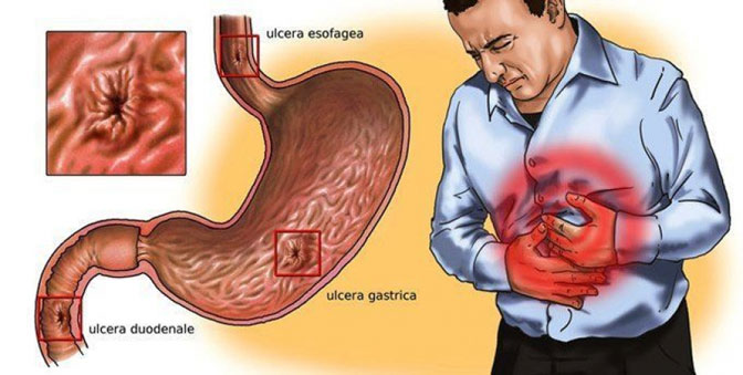 Nervira vas neugodni gastritis